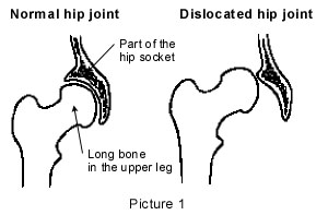 Hip%20Problems%20in%20Infants01.jpg