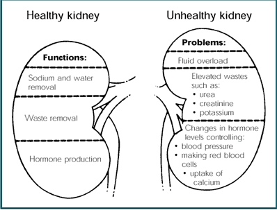 Kidney%20Failure%20-%20Treatment%20Options02.png