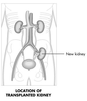 Kidney%20Failure%20-%20Treatment%20Options08.jpg