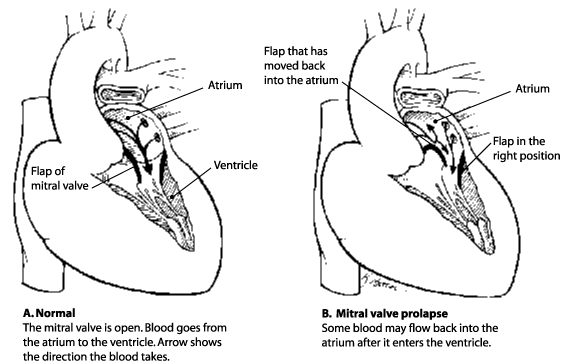 MVP%20-%20Mitral%20Valve%20Prolapse00.png